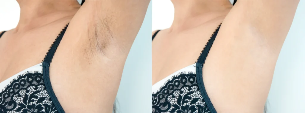 Best Laser hAire Removal