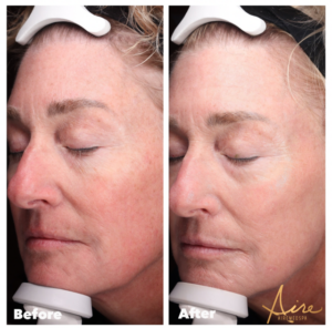 chemical peel