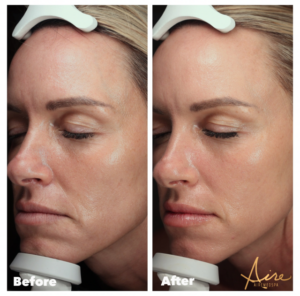 microneedling